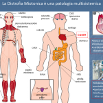 Distrofia Miotonica, una patologia multisistemica